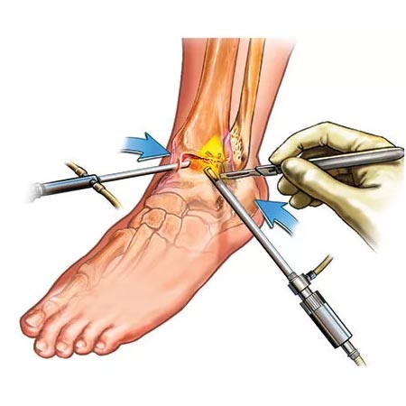 ankle arthroscopy in Vizag