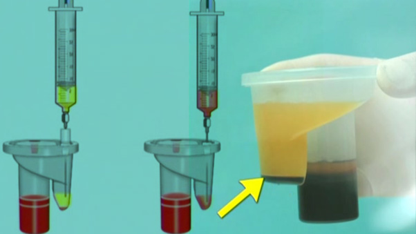 Collection of Bone Marrow aspirate containing stem cells