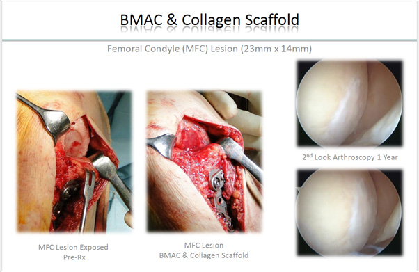 Cartilage Repair