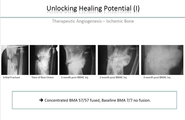 Difficult and worst Non unions BMAC injections will do the miracle very promising results