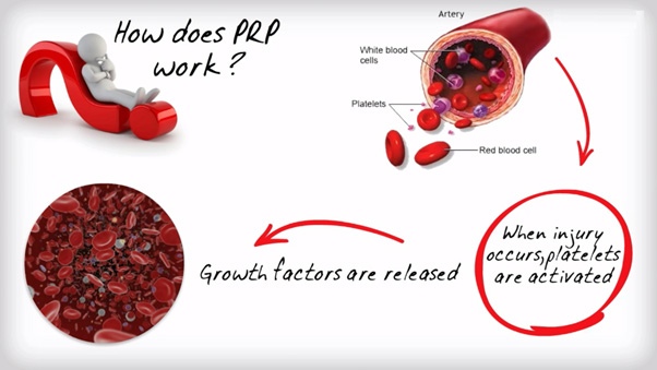 platelet rich plasma