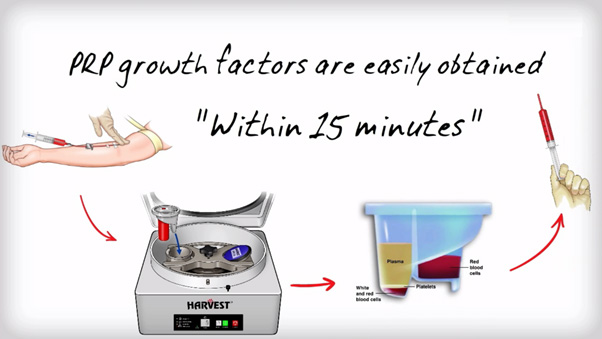 platelet rich plasma