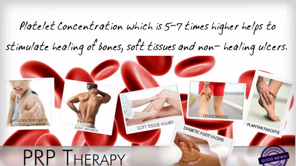 platelet rich plasma