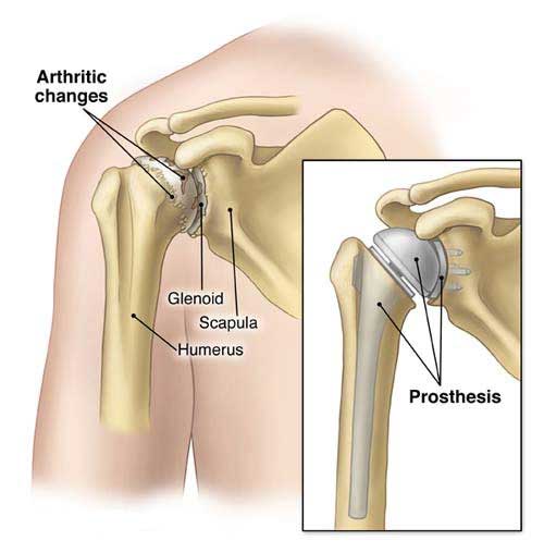 shoulder arthroplasty in Vizag
