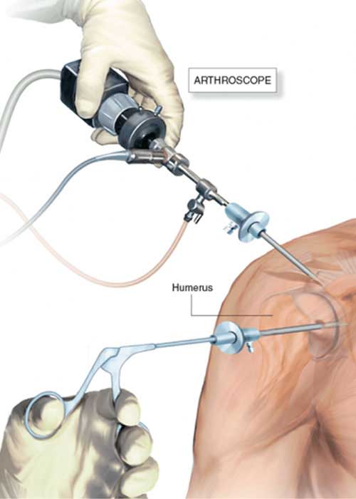 shoulder arthroscopy in Vizag